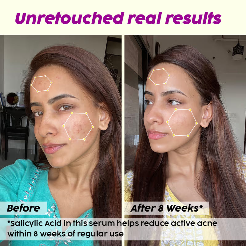 Plix 2% Salicylic Acid Active Acne Care Regime